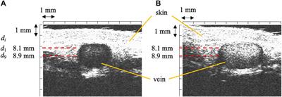 In vivo measurement of attenuation coefficient of blood in a dorsal hand vein in a frequency range of 10–45 MHz: A preliminary study